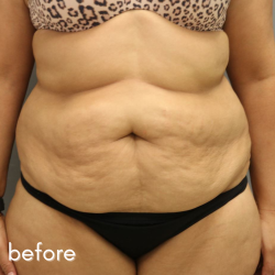 Tummy Tuck Before & After Patient #497