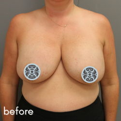 Breast Lift Before & After Patient #574