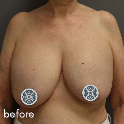 Breast Lift Before & After Patient #584