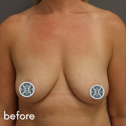 Breast Augmentation Before & After Patient #519