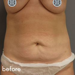 Tummy Tuck Before & After Patient #489