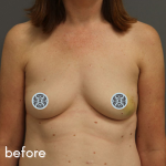 Breast Reconstruction Before & After Patient #529