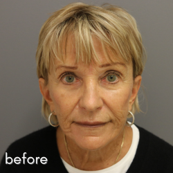 Neck Lift Before & After Patient #544