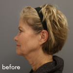 Neck Lift Before & After Patient #552