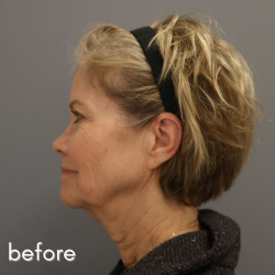 Neck Lift Before & After Patient #552