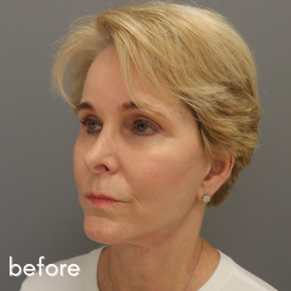 Neck Lift Before & After Patient #560