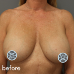 Breast Lift Before & After Patient #569