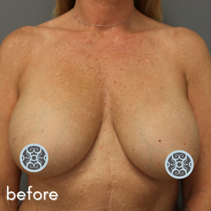Breast Lift Before & After Patient #569