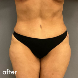 Tummy Tuck Before & After Patient #497