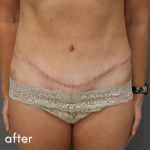 Tummy Tuck Before & After Patient #489