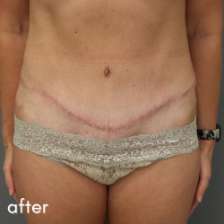 Tummy Tuck Before & After Patient #489