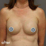 Breast Reconstruction Before & After Patient #529