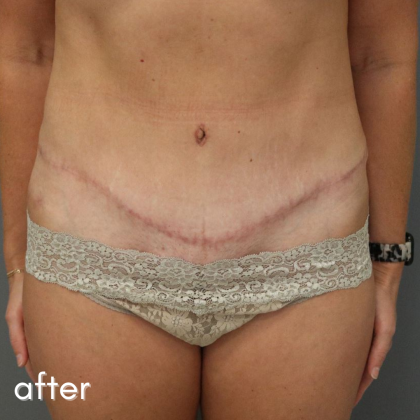 Tummy Tuck Before & After Patient #489