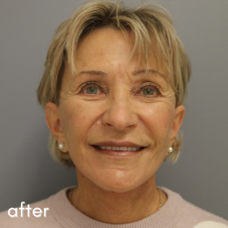 Neck Lift Before & After Patient #544