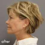Neck Lift Before & After Patient #552