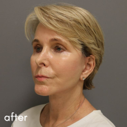 Neck Lift Before & After Patient #560