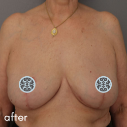 Breast Lift Before & After Patient #584
