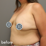 Breast Augmentation Before & After Patient #510