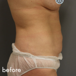 Tummy Tuck Before & After Patient #489