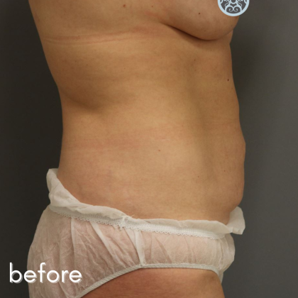 Tummy Tuck Before & After Patient #489