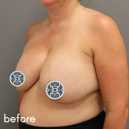 Breast Lift Before & After Patient #574