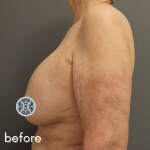 Breast Lift Before & After Patient #584