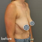 Breast Lift Before & After Patient #592