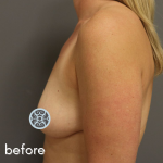 Breast Augmentation Before & After Patient #519