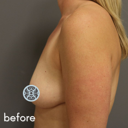 Breast Augmentation Before & After Patient #519