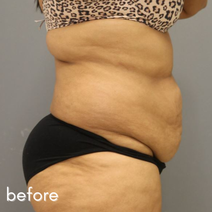 Tummy Tuck Before & After Patient #497