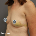 Breast Reconstruction Before & After Patient #529