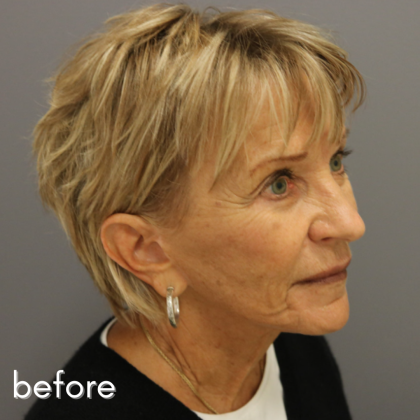 Neck Lift Before & After Patient #544