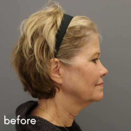 Neck Lift Before & After Patient #552