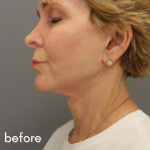 Neck Lift Before & After Patient #560