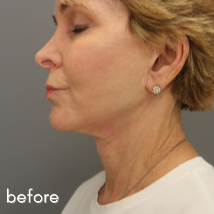 Neck Lift Before & After Patient #560