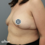 Breast Augmentation Before & After Patient #510