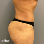 Tummy Tuck Before & After Patient #497