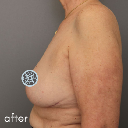 Breast Lift Before & After Patient #584