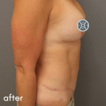 Tummy Tuck Before & After Patient #489