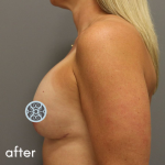 Breast Augmentation Before & After Patient #519