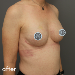Breast Reconstruction Before & After Patient #528