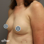 Breast Reconstruction Before & After Patient #529