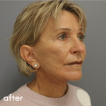 Neck Lift Before & After Patient #544