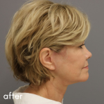 Neck Lift Before & After Patient #552
