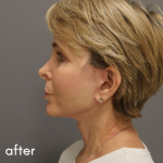 Neck Lift Before & After Patient #560