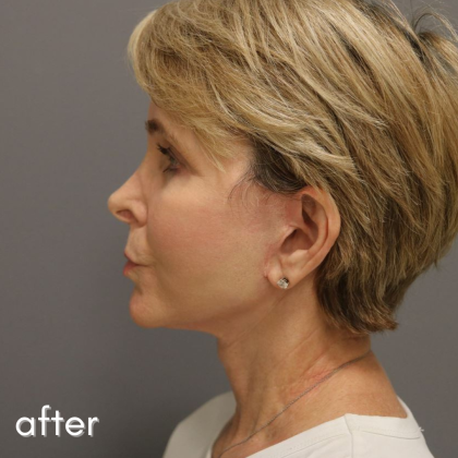 Neck Lift Before & After Patient #560