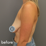 Breast Lift Before & After Patient #592