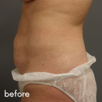 Tummy Tuck Before & After Patient #489