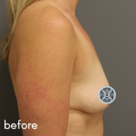 Breast Augmentation Before & After Patient #519