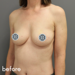 Breast Reconstruction Before & After Patient #528